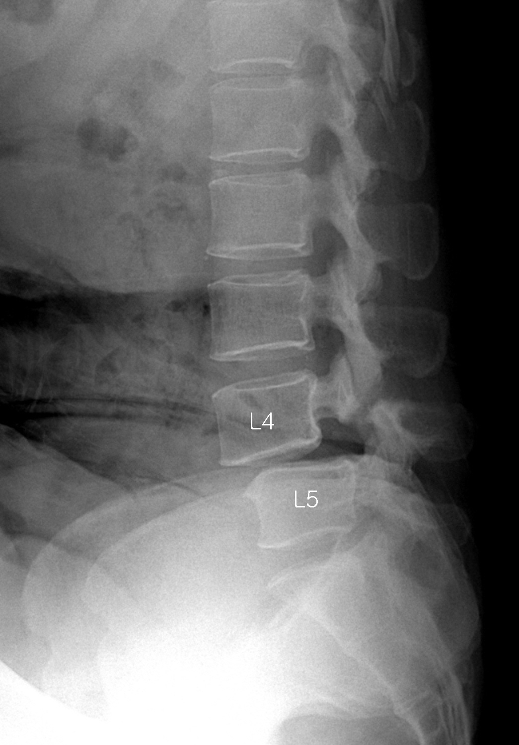 Listhesis cervical c4-c5 Listhesis cervical c4-c5