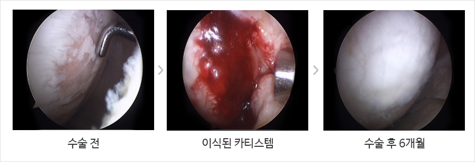 줄기세포 치료슬 수술전사진 이식 된 카티스템사진 수술후 6개월사진