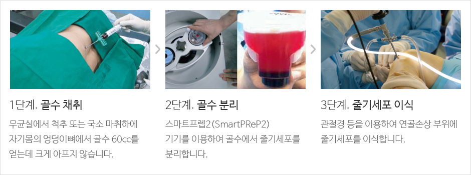 1단계. 골수 채취 무균실에서 척추 또는 국소 마취하에 자기몸의 엉덩이뼈에서 골수 60cc를 얻는데, 크게 아프지 않습니다. 2단계. 골수 분리 스마트프렙2(SmartPReP2)
기기를 이용하여 골수에서 줄기세포를 분리합니다. 3단계. 줄기세포 이식 관절경 등을 이용하여 연골손상 부위에 줄기세포를 이식합니다.