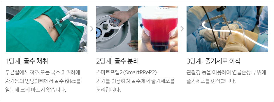 1단계. 골수 채취 무균실에서 척추 또는 국소 마취하에 자기몸의 엉덩이뼈에서 골수 60cc를 얻는데, 크게 아프지 않습니다. 2단계. 골수 분리 스마트프렙2(SmartPReP2)
					기기를 이용하여 골수에서 줄기세포를  분리합니다. 3단계. 줄기세포 이식 관절경 등을 이용하여 연골손상 부위에 줄기세포를 이식합니다. 