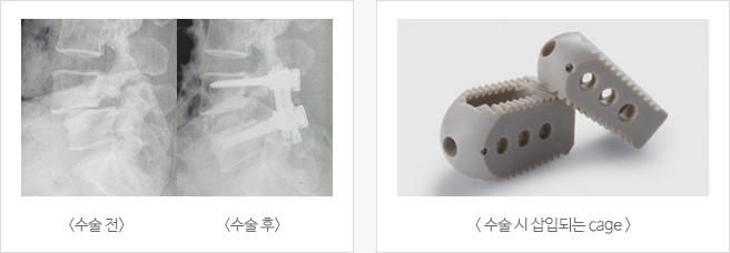수술방법 수술 전,후사진과 수술시 삽입되는 Cage이미지