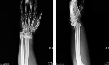손목골절 수술전 사진
