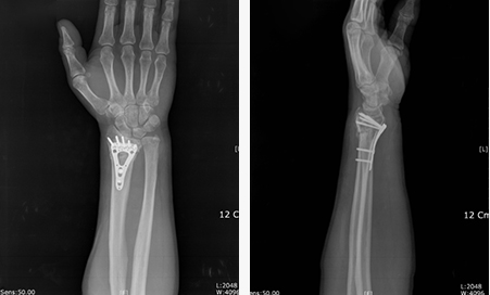 손목골절 수술후 사진