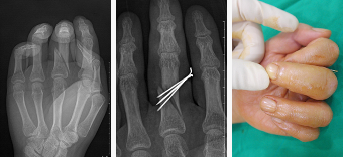 중수골 골절 수술전 사진