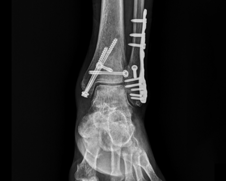 발목 골절 수술후 사진